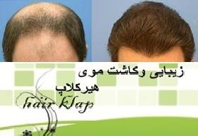 کاشت مو ,کاشت ابرو , hairklap