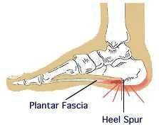 درمان قطعی خار پاشنه (Heel Spur)