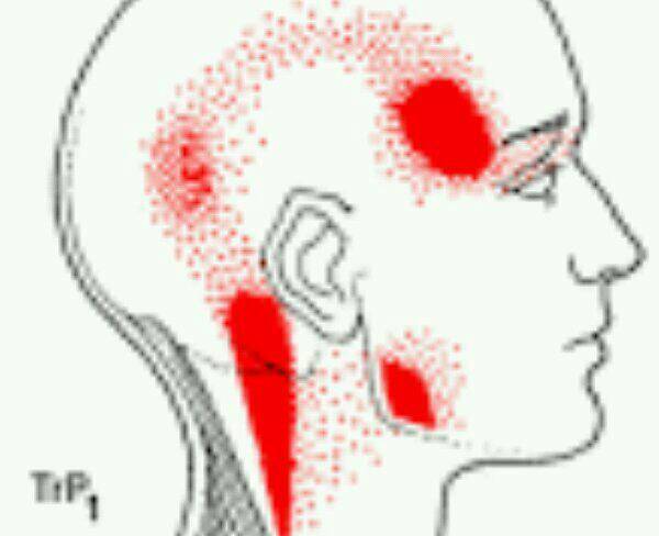درمان سردرد با منشا عضلانی