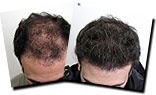 ماینوکسیدیل-minoxidil